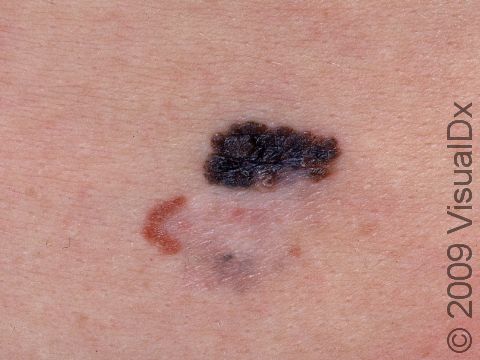 This image displays a melanoma with a white and pink center, a darker black-brown area, and pink and brown c-shaped tumor on the left side of the lesion.