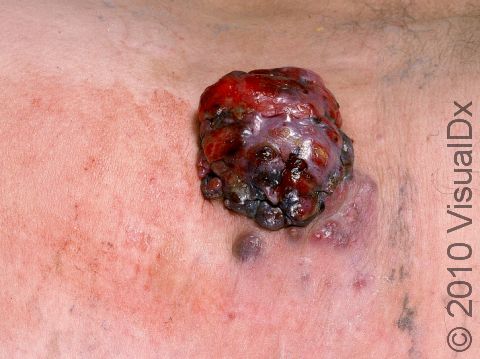 This image displays a round, bleeding melanoma that has a small 