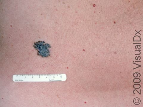 This image displays a melanoma with irregular borders surrounded by many other benign growths, which are much smaller and have regular, circular borders.
