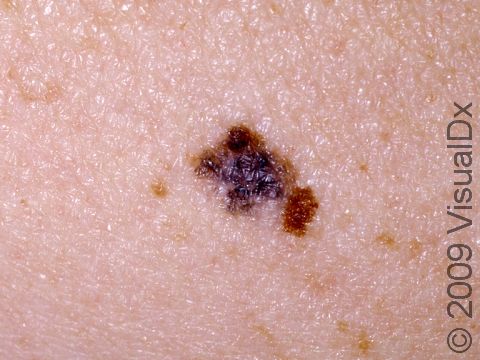 Black, multi-colored, asymmetric, or irregularly shaped lesions all need to be checked by a dermatologist or doctor skilled in looking at moles.