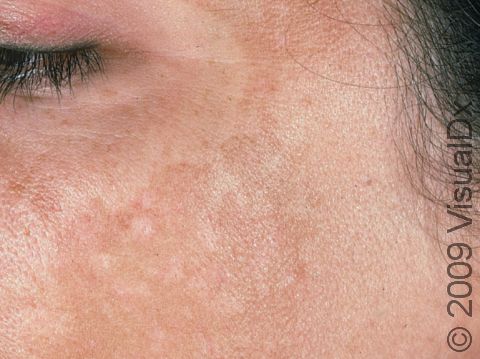 In this image, melasma is on the cheeks and extends to the temple.