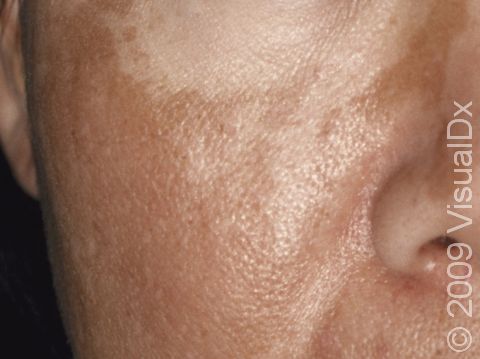 Melasma is a common cause of facial darkening (hyperpigmentation) in women. It is related to hormonal changes and can be worsened by oral contraceptives.