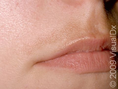 This image displays subtle darkening (hyperpigmentation) of the lip in a woman with melasma.