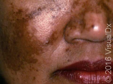 This image displays extensive irregular areas of melasma across the cheeks, nose, and chin.