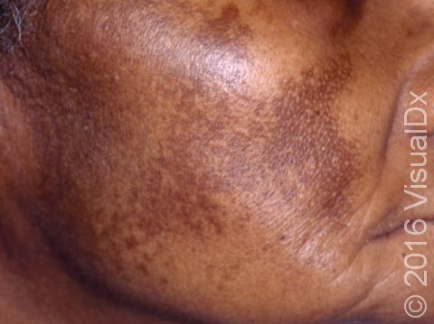 Melasma is particularly noticeable in people with darker skin.