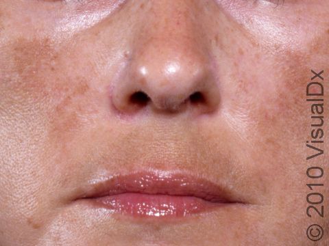 This image displays melasma affecting the cheeks and upper lip.