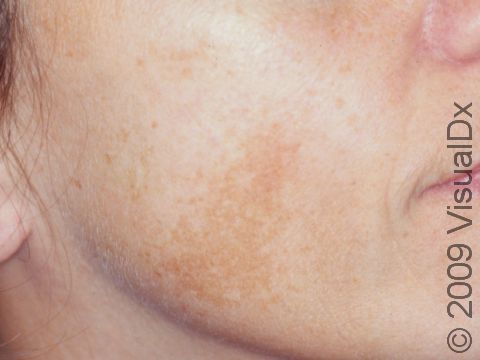 This image displays a lace-like pattern on the cheeks typical of melasma.