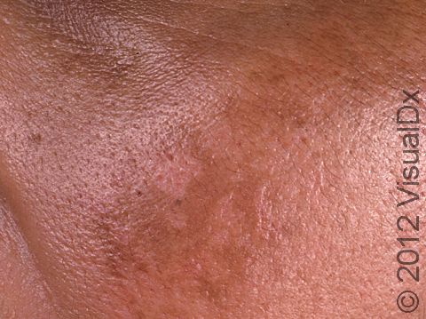 In melasma, which most commonly occurs in females following pregnancy or use of oral contraceptives, the skin is darker, but the lesions are not raised.