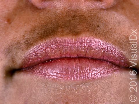A frequent location for the increased darkness (pigmentation) seen in melasma is the upper lip.