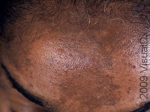 As displayed in this image, melasma, while usually affecting the cheeks and lips, can also appear on the forehead.