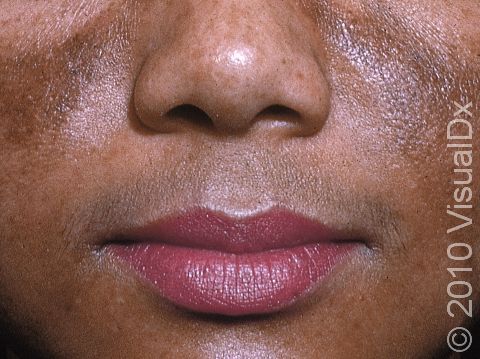 This image displays melasma on the lips and cheeks.