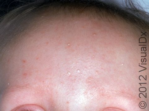 This image displays milia, the small, white bumps at the center of the forehead.