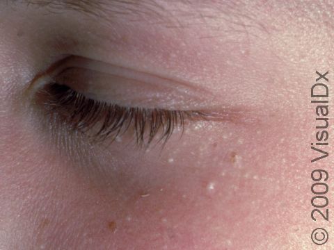 Tiny seed-pearl-like bumps of milia are common around the eye.