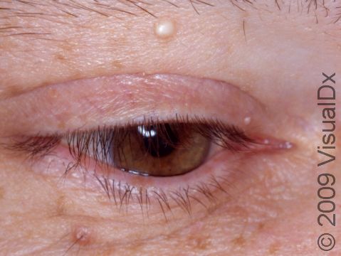 This image displays two milia lesions, one just below the eyebrow and another at the upper-inner eye corner.