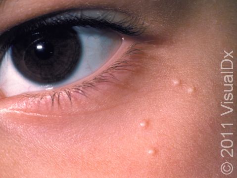 Milia are small superficial cysts filled with flakes of skin cells, not pus.