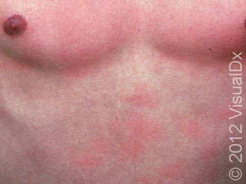 Miliaria rubra can also appear as blotches of red or pink skin.