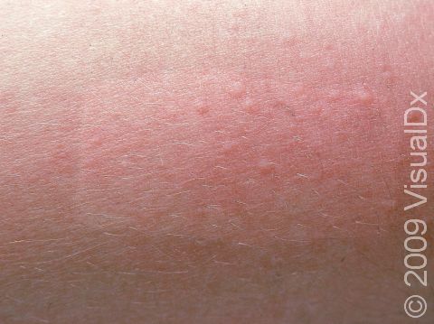 The small skin bumps (papules) of miliaria rubra often appear within red or pink areas of skin.