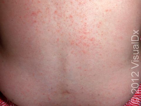In miliaria rubra, the blocked sweat ducts often appear as dozens to hundreds of small pink or red bumps, all approximately the same size and shape.
