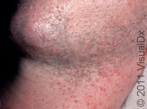 Miliaria rubra is the medical term for heat rash. Typically, there are hundreds of small, itchy bumps, as seen here.