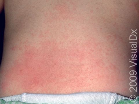 This child with miliaria rubra has many red, itchy bumps in area of redness.