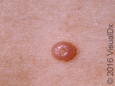 Molluscum contagiosum is a benign poxvirus infection that typically has a central depression.