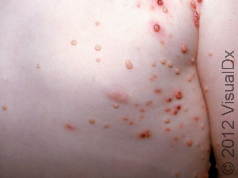 Some of the numerous molluscum lesions on this childs trunk and arm are the skin-colored bumps with a slight depression that are typical of molluscum, while others are red and scabbed.