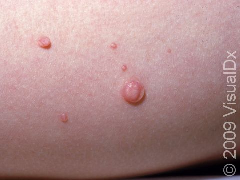 This image displays round, skin-colored bumps typical of molluscum.