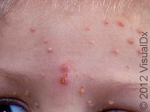 This image displays lesions from a skin infection with a poxvirus, molluscum contagiosum.