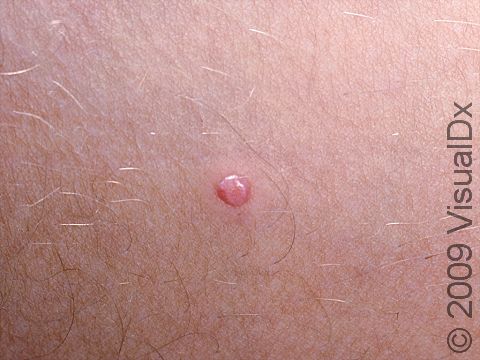 As displayed in this image, molluscum appear smooth and can be either skin-colored or, if inflamed, pink.