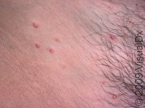 Molluscum Contagiosum Condition, Treatments and Pictures for Teens -  Skinsight