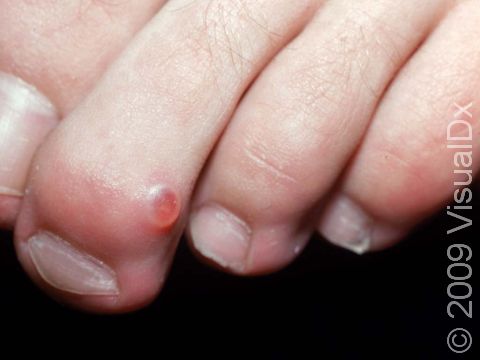 Myxoid cysts can occur on the toes.