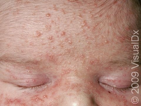 Acne whiteheads and bumps (papules) typically involve the forehead in neonatal acne.