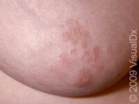 Nipple Dermatitis