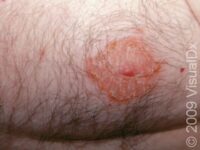 Nipple Dermatitis