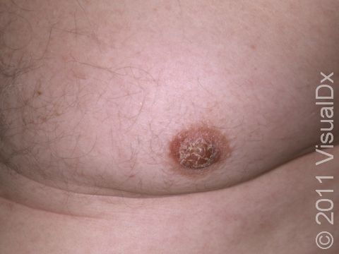 In nipple dermatitis, there is dryness and scaling over the nipples. 