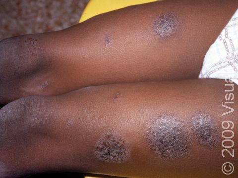 This image displays nummular dermatitis on a Black patient, where the round, scaly areas of skin can become darker in color.