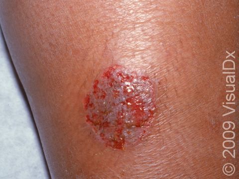 This image displays a round, scaly area that has been eroded by scratching, typical of nummular dermatitis.