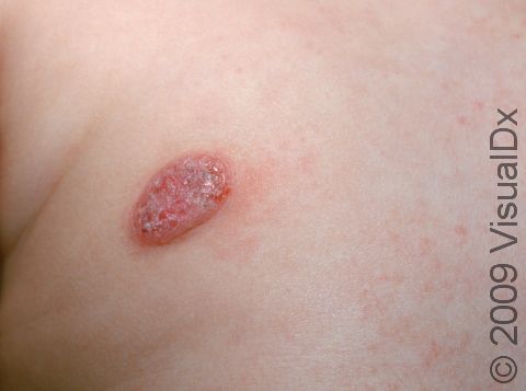 This image displays the typical round to oval shape of nummular eczema coupled with some oozing and swelling.