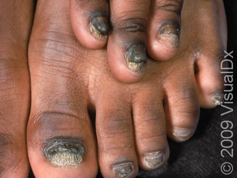 This image displays thick, uneven, rough nails typical of onychomycosis.