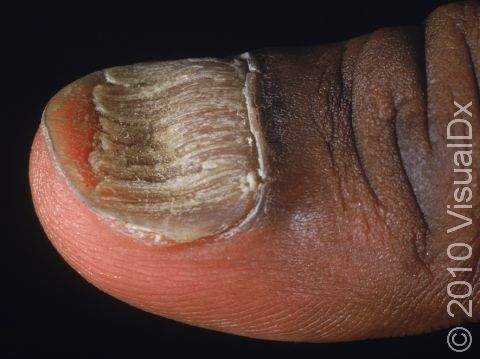 Onychomycosis can cause roughness of the nail and a distorted shape.