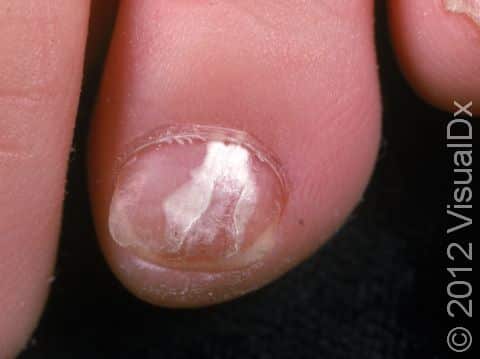 Onychomycosis can cause white areas in the nail.