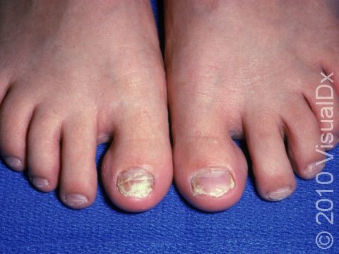 Nail Infection, Fungal (Onychomycosis) Condition, Treatments and Pictures  for Teens - Skinsight