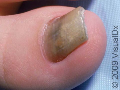 The great toenail is the most likely area to be affected with a fungus, with discoloration and thickening of the nail plate.