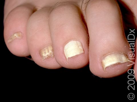 How Tanya beat unsightly Nail Fungus - A Step Ahead Foot + Ankle Care