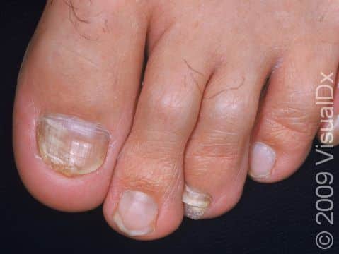 The great and third toenails show the thickened and slightly discolored appearance typical of fungal infection.