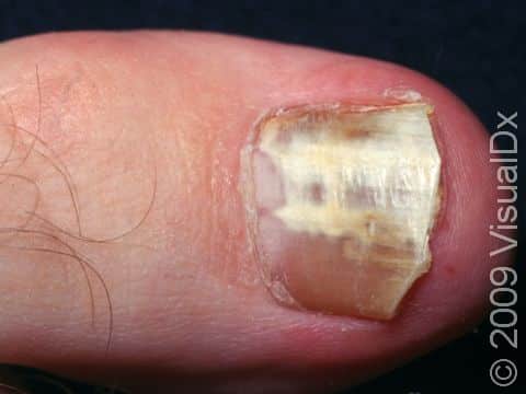 This form of fungal nail infection is call 