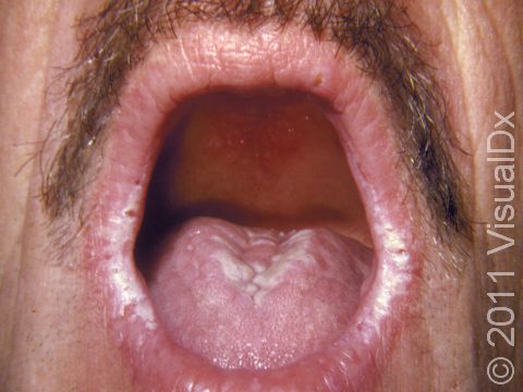 White, slightly elevated lesions on the tongue and lips are typical of oral candidiasis.