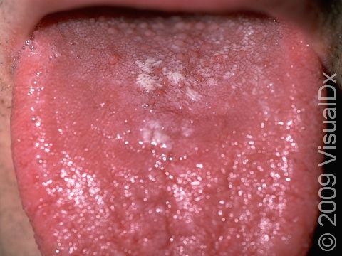 Oral candidiasis (thrush). The white, slightly elevated lesions appear to be 