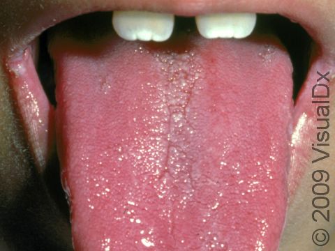 The slight shiny redness of the tongue and the cracks at the mouth corners are typical of oral candidiasis, also known as thrush, a yeast infection inside the mouth.