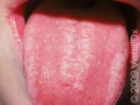 Thrush (Oral Candidiasis)